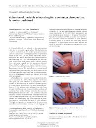 Image result for Labial Fusion