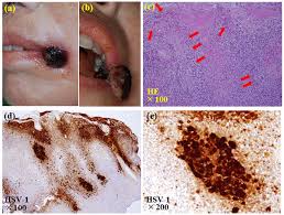 Avoid passing herpes to your partner. Hypertrophic Herpes Simplex Virus Type 1 Infection In A Patient With Acute Myeloid Leukemia Ogawa Journal Of Hematology
