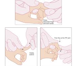 Image result for Lateral PIP Dislocation