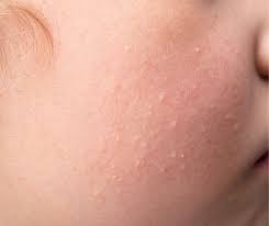 Image result for Keratosis pilaris
