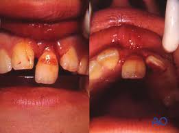 Image result for Tooth Luxation