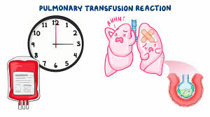Image result for Transfusion Associated Circulatory Overload