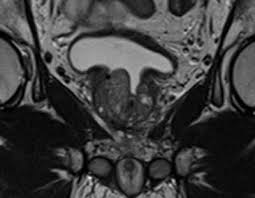 Why is turp (transurethral resection of the prostate) performed? Transurethral Resection Of The Prostate List Of Frontiers Open Access Articles