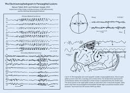 Image result for Absence Seizure