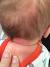 Stork Bite Back Of Neck