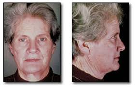 The Complete Denture Prosthesis: Clinical and Laboratory Applications