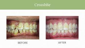 Crossbites and crooked teeth can impacts the way you eat, breath and even speak! Invisalign For Crossbite Can Invisalign Fix Crossbite