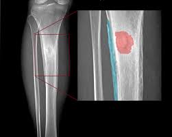 Image result for Osteomyelitis
