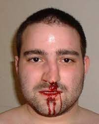 Nobody Nose Punched On Face Rcemlearning Netherlands