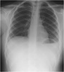 There are some picture/pictures on the walls. Showing Normal Appearance Of The Left Diaphragm With Normal Lung Download Scientific Diagram