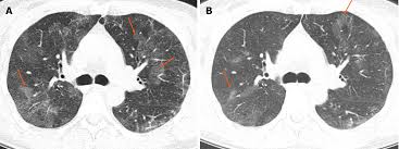 Chronic Airspace Disease Review Of The Causes And Key Computed Tomography Findings