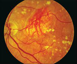 Age-related macular degeneration - The Lancet