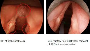 An endoscopic medical image showing papillomas on the vocal cords of a patient with RRP. (gstatic.com)