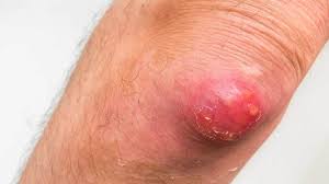 Infections are categorized based on the part of the body infected. Herpetic Whitlow Symptoms Causes And Diagnosis