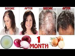 How To Regrow Hair Faster Long Thick Onion Juice For Hair Regrowth Hair Loss Cure Youtube Regrow Hair Fast Onion Juice For Hair Hair Growth Faster