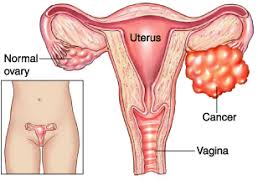 Why should i choose memorial sloan kettering for ovarian cancer treatment? What Is Ovarian Cancer Medikoe