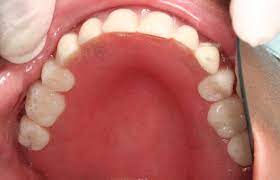 We did not find results for: The Average Cost Of Root Canal And Crown In Los Angeles