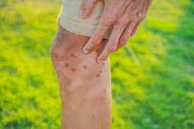 Image result for mite bites on humans