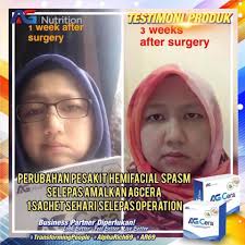 Bell's palsy ditandai dengan kelemahan atau kelumpuhan sementara pada salah satu sisi wajah. Apakah Itu Bell S Palsy Ag Nutrition Ag Cera