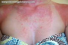 It might be a sun allergy. Psa Your Sun Heat Rash May Be A Reaction To The Chemicals In Your Sunscreen Skincareaddiction