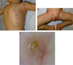Image result for scabies human children