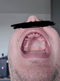 Image result for Alveolitis sicca)