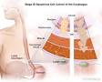 Image result for esophageal cancer silkworm