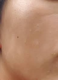 Started in 1995, this collection now contains 6963 interlinked topic pages divided into a tree of 31 specialty books and 737 chapters. Skin Concerns How To Cure My Skin From Pityriasis Alba Skincareaddiction