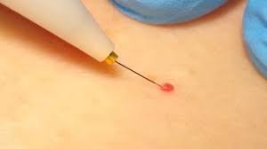 This video is about #cherryangioma removal update. Milia Extraction Cherry Angioma Removal With Electrolysis Youtube