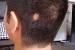 Scalp Inflammation Hair Loss