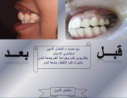 Khartoum Dentist - تقويم الاسنان مع د/الفاضل فاروق | Facebook