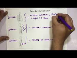 Spine Curvature Disorders Scoliosis Kyphosis Lordosis Youtube