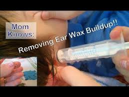 How to put hydrogen peroxide in ears. Removing Ear Wax Buildup At Home Flushing Out Ear Wax W Hydrogen Peroxide Ear Irrigation Review Youtube