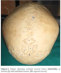 {{}}cranial suture a type of joint between the bones of the skull where the bones are held tightly together by fibrous tissue. Human Skull With Complete Metopic Suture And Multiple Sutural Bones At Lambdoid Suture A Case Report
