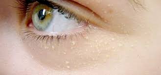 Image result for xantelasma