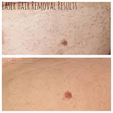 When performed correctly, laser hair removal kills the follicle of hair and is extremely targeted without affecting the skin. Pin On Reviews Comparisons Random Things My Blog