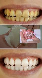 Limpieza Dientes Limpieza Dientes Blanqueador De Dientes Y Caries