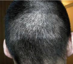 Where is the highest density of hair on the head? Determining Safe Excision Limits In Fue Factors That Affect And A Simple Way To Maintain Aesthetic Donor Density Hair Transplant Forum International