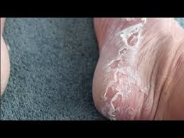 An internal cause of peeling skin on the foot can be a genetic disorder that causes dry, cracked, thickened skin 1. Foot Peel Kit Treatment Review Youtube