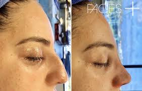 Before And After Rhinoplasty Surgery By Dr Cohen In San Diego Ca Rhinoplasty Surgery Rhinoplasty Before And After Rhinoplasty