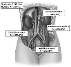 Cancer is a disease in which cells in the body grow out of control. Preoperative Conization And Risk Of Recurrence In Patients Undergoing Laparoscopic Radical Hysterectomy For Early Stage Cervical Cancer A Multicenter Study Journal Of Minimally Invasive Gynecology