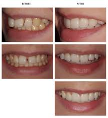 The vast majority of orthodontic professionals will actually fit you for a retainer in order to get rid of the flared teeth that you currently have. Inman Aligner Before And After Pictures Inman Aligner