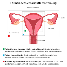 Dies kann durch gutartige oder auch durch bösartige. Gebarmutterentfernung Ursachen Ablauf Prognose