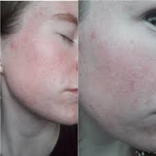 Free shipping + loyalty rewards. Skin Concerns Any Recommendations On How To Reduce Redness Large Pores And Uneven Texture Troubled By What This Could Be Skincareaddiction