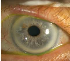 Die neuesten tweets von kornea (@teamkornea). Oph5 Kornea Hornhaut Flashcards Quizlet