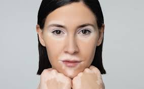 La vitiligine è un disordine dermatologico che causa la formazione di macchie bianche sulla pelle dovute all'inattivazione della cellula deputata alla . Vitiligine Origine Problematiche Soluzioni Vogue Italia