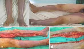 Unfortunately, due to the rarity of the disease as well as the fact that diagnosis is made in the operative theater, delay in diagnosis is common. Risk Factors Of Synchronous Multifocal Necrotizing Fasciitis A Case Control Study In Comparison With Monofocal Necrotizing Fasciitis In Taiwan Bmc Infectious Diseases Full Text