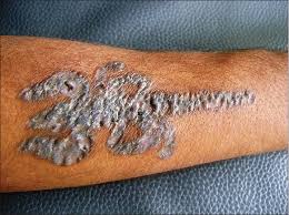 What exactly is a pogger? Indian Journal Of Dermatology Venereology And Leprology Granuloma Annulare Like Palisading As A Histological Reaction To A Tattoo