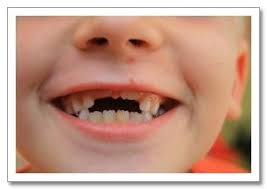 Smile And The World Smiles With You Tooth Decay In Children Teeth Treatment Dental Implants Cost