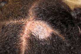 Image result for Tinea Capitis